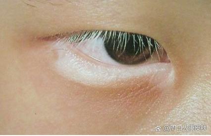 睫毛发白是什么原因导致的_睫毛变白原因及应对方法