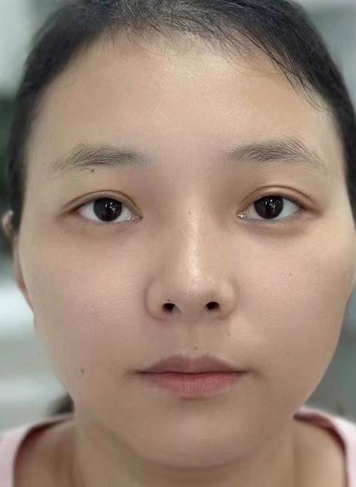 不化妆照片鼻子看着不挺_不化妆鼻子塌?医美或真管用! 不化妆照片鼻子看着不挺_不化妆鼻子塌?医美或真管用!