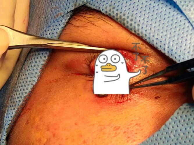 下眼睑没有睫毛是什么原因_睫毛缺失?遗传受伤疾病都可能导致! 下眼睑没有睫毛是什么原因_睫毛缺失?遗传受伤疾病都可能导致!