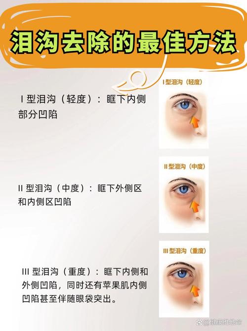 先提亮还是先遮泪沟_眼窝提亮遮泪沟，粉底避开泪沟，高光提亮眼