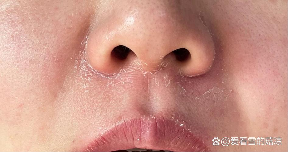 一化妆鼻子就起皮_鼻子化妆起皮？皮肤屏障受损，这样修复