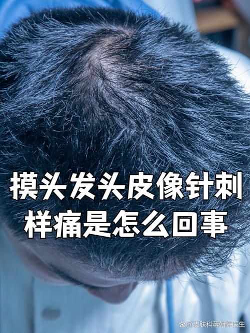 一碰头发感觉头皮疼,摸起来又不疼_头发扎紧头皮疼?别大意! 一碰头发感觉头皮疼,摸起来又不疼_头发扎紧头皮疼?别大意!