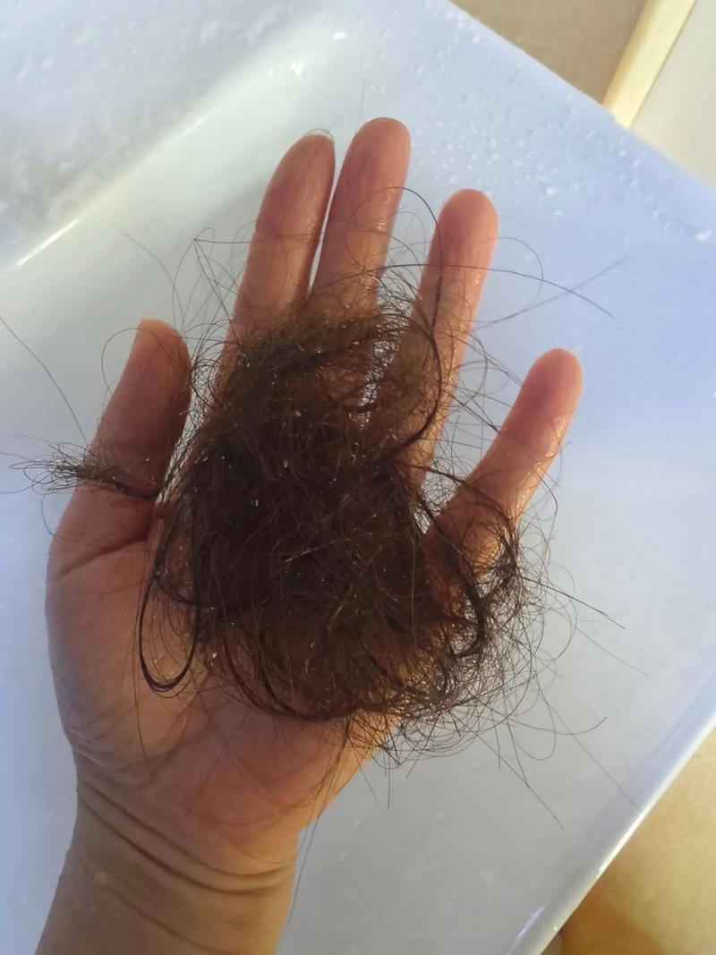 洗一次头掉50根头发正常吗_脱发50根正常?补营养护头皮可改善 洗一次头掉50根头发正常吗_脱发50根正常?补营养护头皮可改善