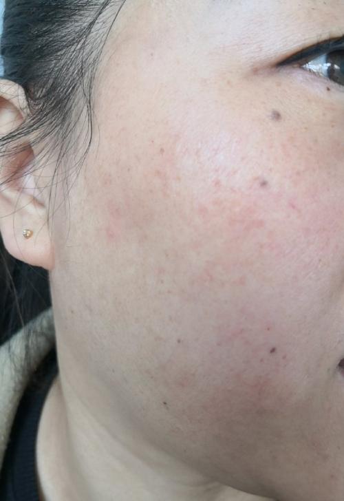 用完化妆品脸发红长红点_化妆品过敏红肿?停用清洁加舒缓! 用完化妆品脸发红长红点_化妆品过敏红肿?停用清洁加舒缓!