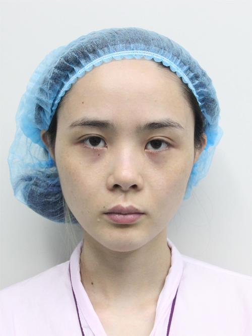 假体隆鼻多久可以化妆_假体隆鼻后几天能化妆? 假体隆鼻多久可以化妆_假体隆鼻后几天能化妆?