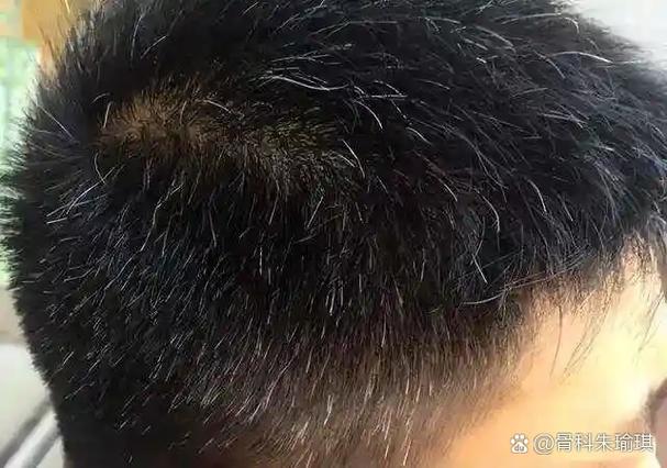 拔掉白头发会不会越长越多_别信谣言!拔白发不增多,伤毛囊 拔掉白头发会不会越长越多_别信谣言!拔白发不增多,伤毛囊