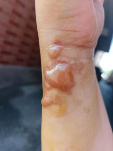 手被卷发棒烫伤火辣辣疼要多久_手指卷发棒烫伤急救与恢复