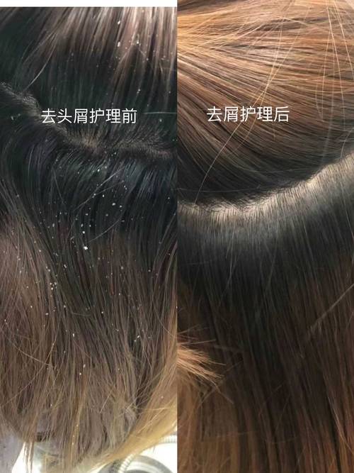 煤焦油和二氧化硒哪个洗头发好_敏感头皮选温和煤焦油，重脂溢选强效二氧化硒