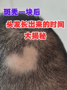 秃斑是没头发还是看着少就是秃斑_斑秃秃斑治疗与预防
