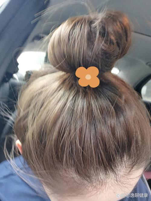 甲状腺手术多久染头发_甲状腺手术一个月后可染发,伤口愈合好再染 甲状腺手术多久染头发_甲状腺手术一个月后可染发,伤口愈合好再染