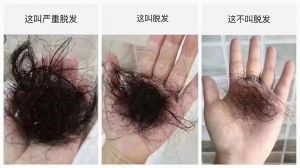 捋一下头发掉几根算脱发_脱发超100根要当心，注意生活习惯和就医
