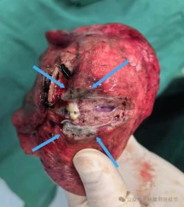 结节手术前能染头发吗_结节手术前慎染发，一周内别碰！