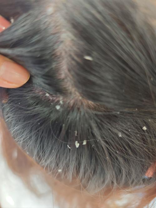 烫完头发掉头皮屑正常吗_烫发头屑多？刺激屏障失衡惹的祸！