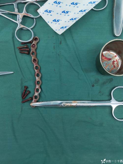 锁骨内固定器械_恢复行动,重获自由 锁骨内固定器械_恢复行动,重获自由