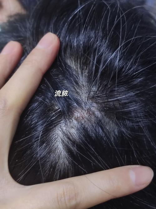 摸头发头皮像针刺样痛_摸头头皮刺痛？原因和处理方法