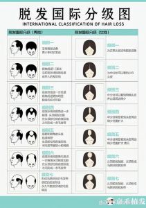 人一天掉多少头发正常_脱发超100根天？当心病理性脱发！