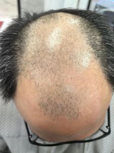 十五天头发长度明显吗_头发长得慢？营养睡眠是关键！