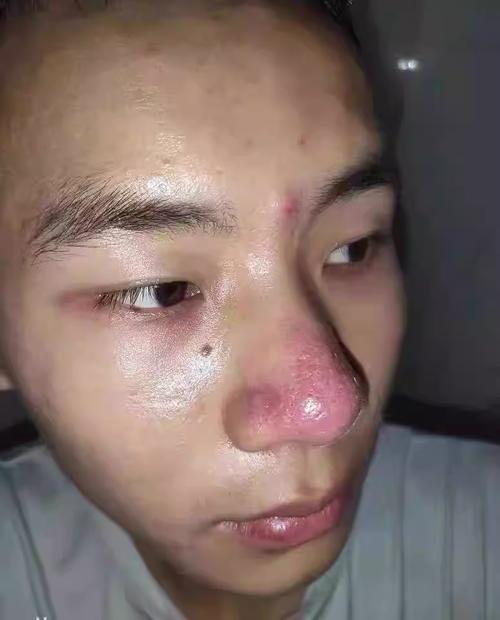 一用化妆品鼻子就红_化妆品致鼻红？选温和品，屏障受损勤修复