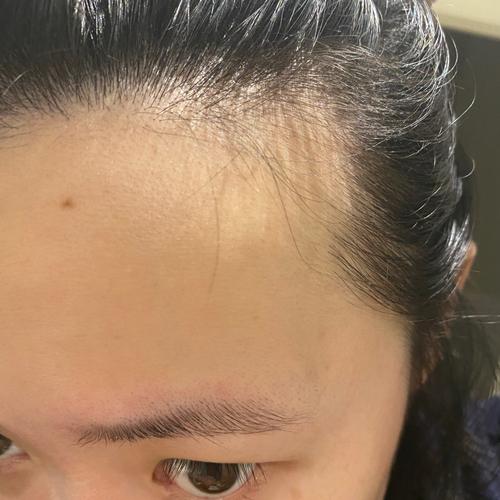 命理发际线两侧额角没头发_额角脱发多因啥？调整饮食作息是关键