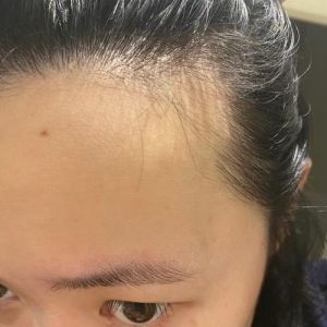 命理发际线两侧额角没头发_额角脱发多因啥？调整饮食作息是关键