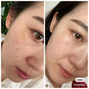 做过激光的脸适合用那种化妆品_激光后皮肤敏感？温和清洁修复防晒很重要！