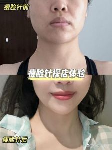 打完瘦脸多久可以化妆_瘦脸针注射后多久见效？注意事项解析