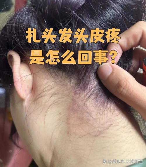 半边头皮疼痛一摸头发就痛_半边头皮疼?神经痛或感染找上门 半边头皮疼痛一摸头发就痛_半边头皮疼?神经痛或感染找上门