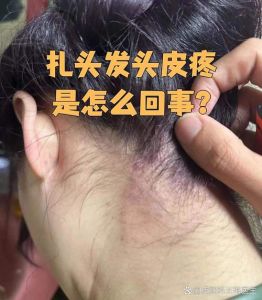 半边头皮疼痛一摸头发就痛_半边头皮疼？神经痛或感染找上门