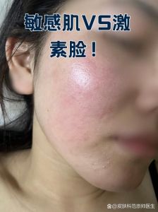 激素化妆品停用后_停用激素化妆品后如何修复皮肤屏障？