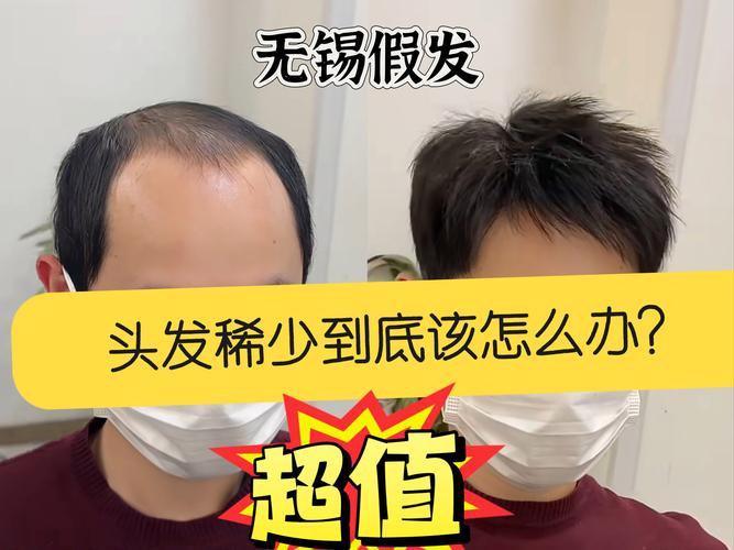 19岁头发稀少怎么办_脂溢脱发怎么办？看这里！