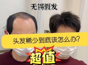19岁头发稀少怎么办_脂溢脱发怎么办？看这里！
