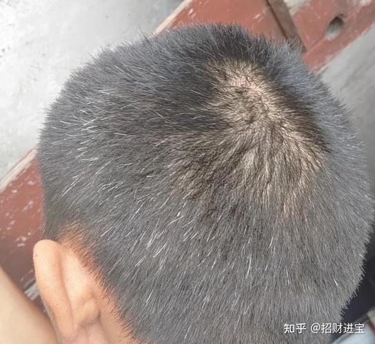 头两侧头发稀少但是头顶不少_M型脱发怎么办？