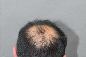 老掉头发_脱发原因多，调整生活习惯或可改善