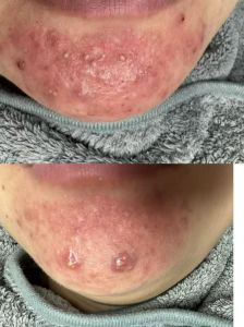 痘痘挤破了还能化妆吗_挤痘痘后别马上化妆，等它好再涂！