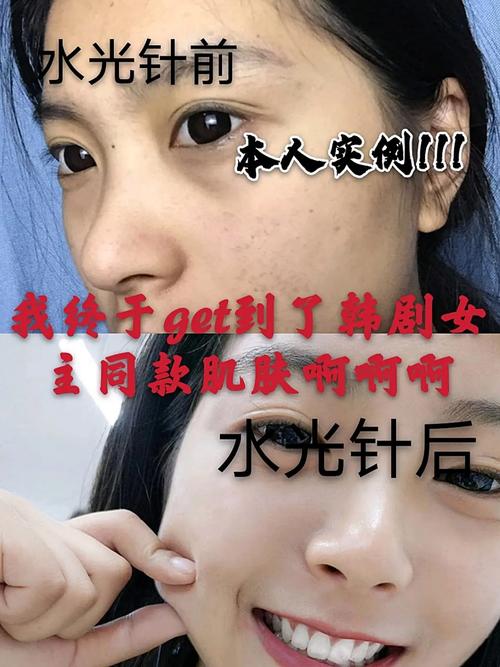 打完水光针几天可以化妆_打完水光针多久能化妆？恢复期护理全攻略