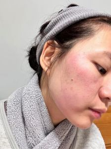 脸突然对所有化妆品过敏_皮肤突然过敏？快停用找原因！