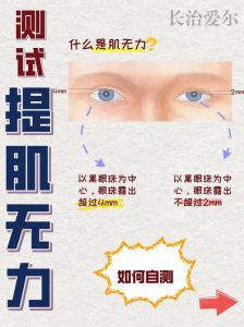 上眼皮肌无力怎么锻炼_上睑下垂锻炼恢复视功能