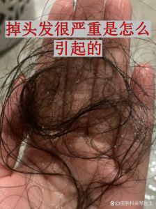 轻轻一扯就掉头发正常吗_脱发多？看这原因和怎么办