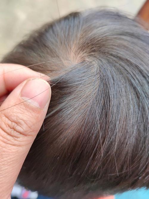 长了一根白头发_遗传饮食压力日晒