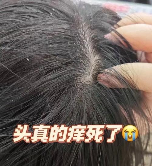 昨天刚洗头发今天就头痒_头皮痒?查查原因,温和护理是关键! 昨天刚洗头发今天就头痒_头皮痒?查查原因,温和护理是关键!