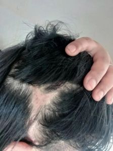 摸一下头发稍微动一下头就疼_头皮一碰就疼？原因和处理方法