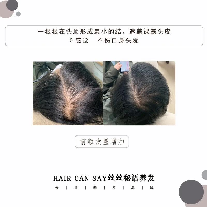 头中间头发稀少能恢复吗_头顶稀少能恢复吗？看原因！