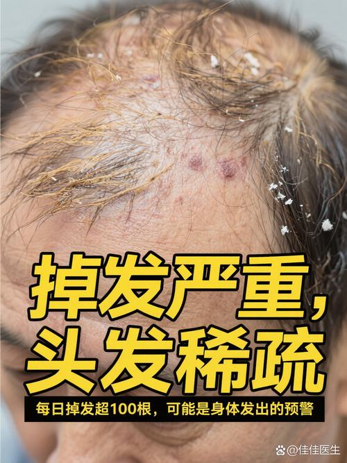 打黄体酮会掉头发吗_黄体酮或致脱发?因人而异需注意 打黄体酮会掉头发吗_黄体酮或致脱发?因人而异需注意