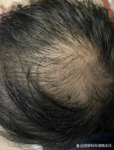 遗传性头发稀少又软又少_遗传脱发软稀？基因敏感是主因，营养作息也重要！