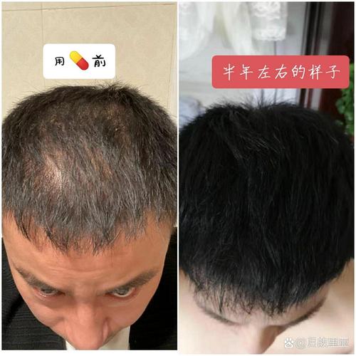 用米诺熬夜还能长头发吗_熬夜脱发米诺地尔管用吗?试试这方法! 用米诺熬夜还能长头发吗_熬夜脱发米诺地尔管用吗?试试这方法!