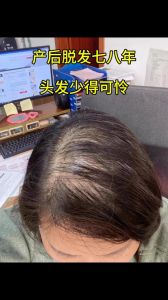 左边头发比右边稀少_左边头发稀少？遗传生活习惯都可能是原因