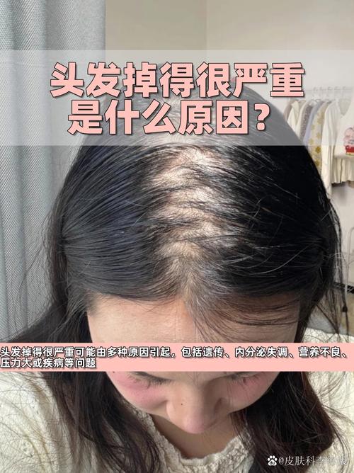 甲醛超标会掉头发吗_甲醛超标危害大,通风选环保很重要! 甲醛超标会掉头发吗_甲醛超标危害大,通风选环保很重要!