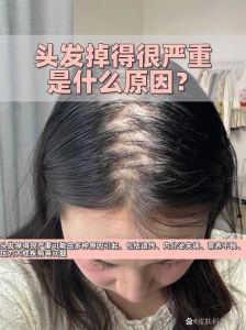 甲醛超标会掉头发吗_甲醛超标危害大，通风选环保很重要！