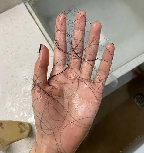 疯狂掉头发一抓就一把_压力大 营养差伤发，脱发及时就医