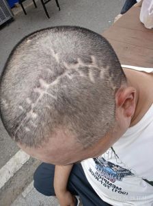 左前大脑一碰头发头皮就像针扎一样疼_左边头皮一碰就疼像针扎？快查原因！